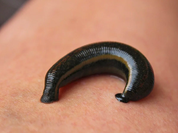 लीच थेरेपी