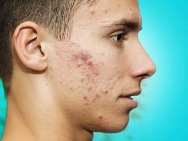 पिंपल्स पिंपल्स