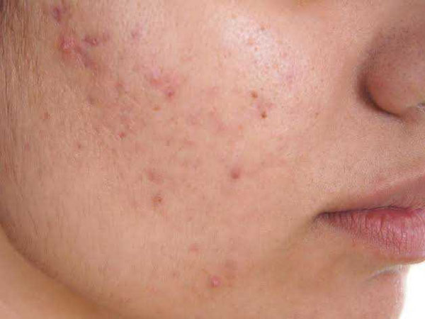 बार बार क्यो होते है एक्ने बार बार क्यो होते है एक्ने