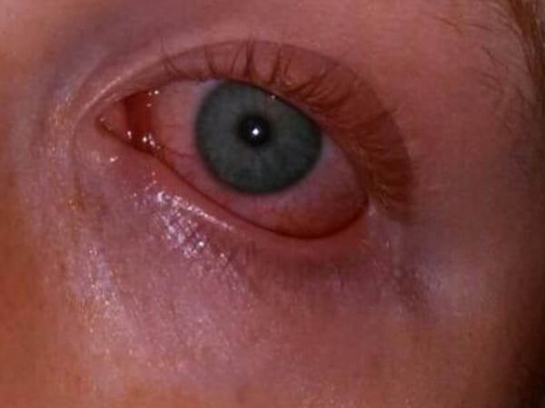 Coronavirus may cause pink eye or conjunctivitis in monsoon