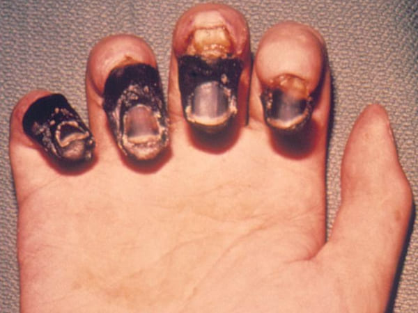 ब्यूबोनिक प्लेग के लक्षण