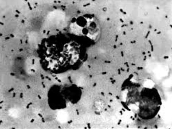 ये कारण है इस बीमारी के