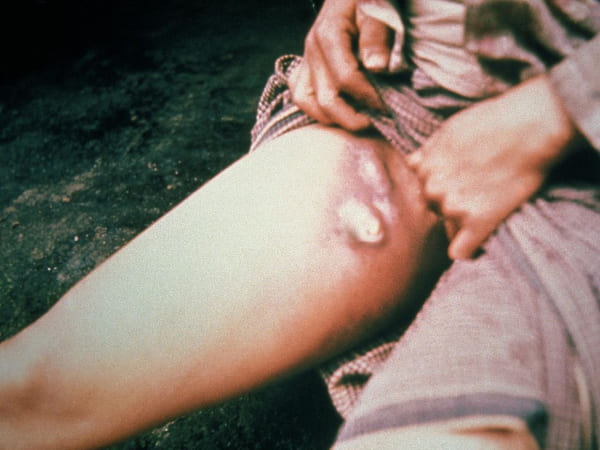 इस बैक्‍टीर‍िया की वजह से फैलती है ये बीमारी