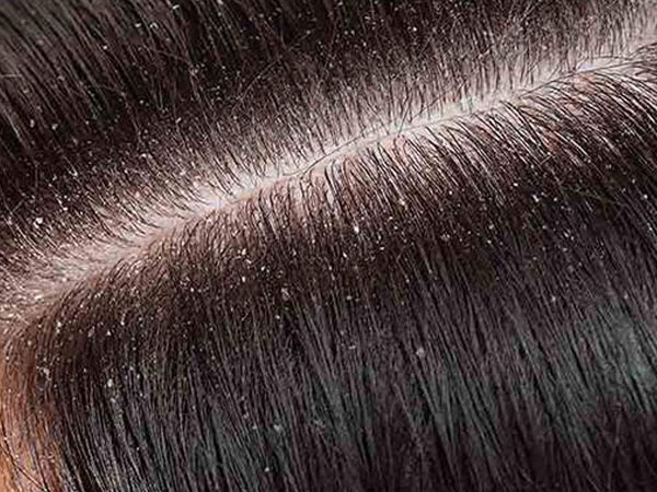 डैंड्रफ से निजात