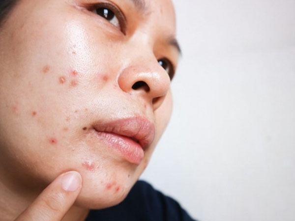 पिंपल से छुटकारा