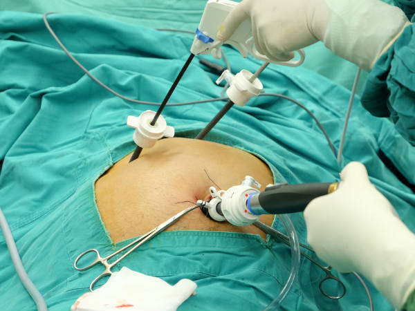 दवाओं ने नहीं निकलता गॉलस्टोन, सर्जरी ही विकल्प