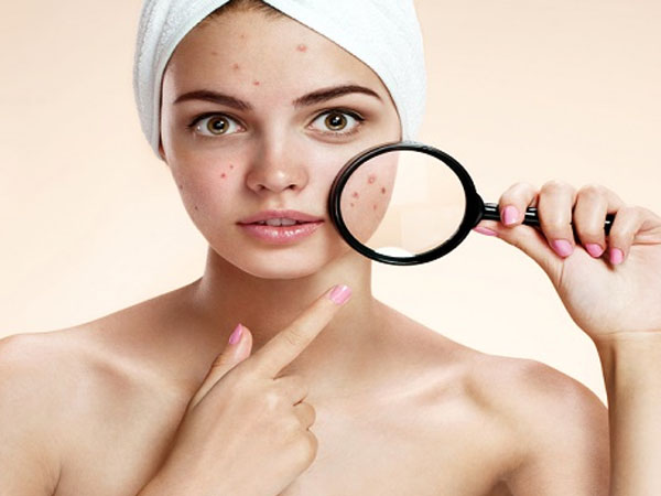 पिंपल और एक्ने से राहत पाने के लिए ओवरनाइट ब्यूटी टिप्स पिंपल और एक्ने से राहत पाने के लिए ओवरनाइट ब्यूटी टिप्स