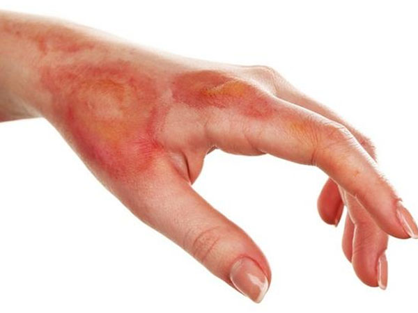 आग से जलना