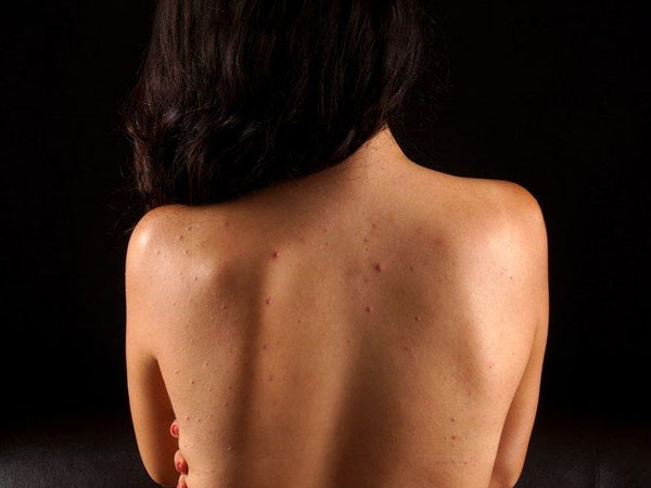 एक्ने फाइटिंग बॉडी वॉश का करें इस्तेमाल