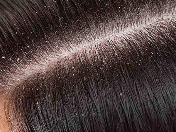 डैंड्रफ से पाएं निजात