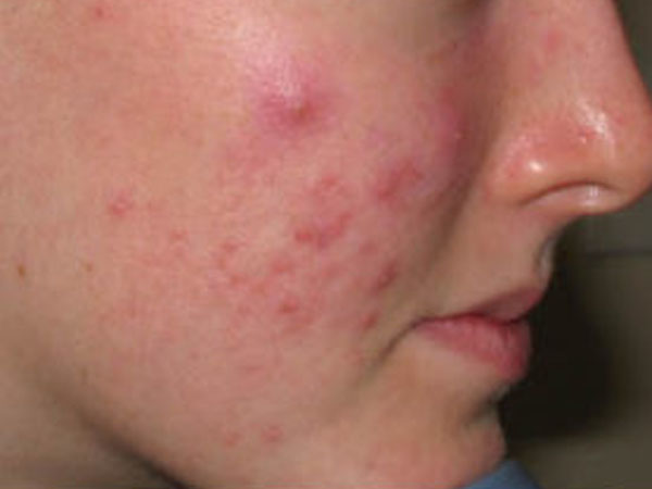 पिंपल और मुंहासे