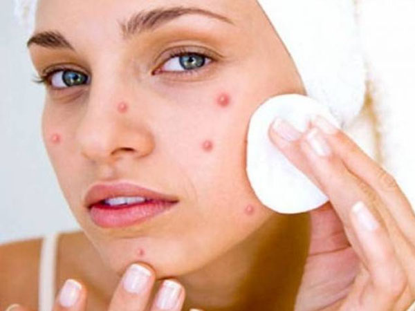 पिंपल और मुंहासे के दौरान ना लगाएं ब्लीच पिंपल और मुंहासे के दौरान ना लगाएं ब्लीच