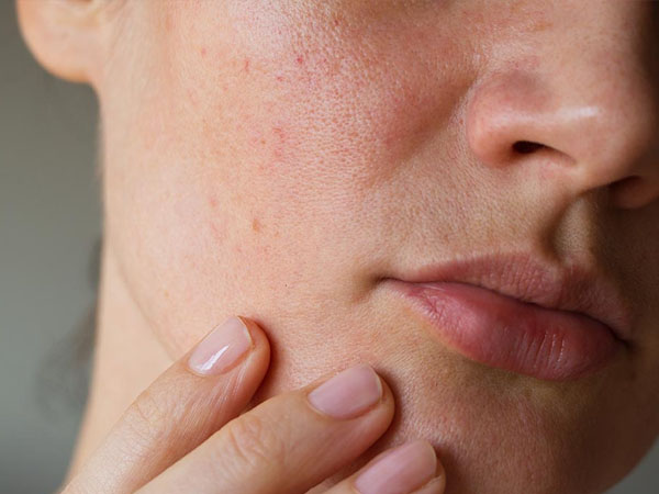 पोर्स को क्लॉग कर सकता है