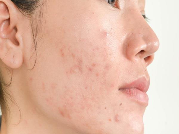 मुंहासों से छुटकारा