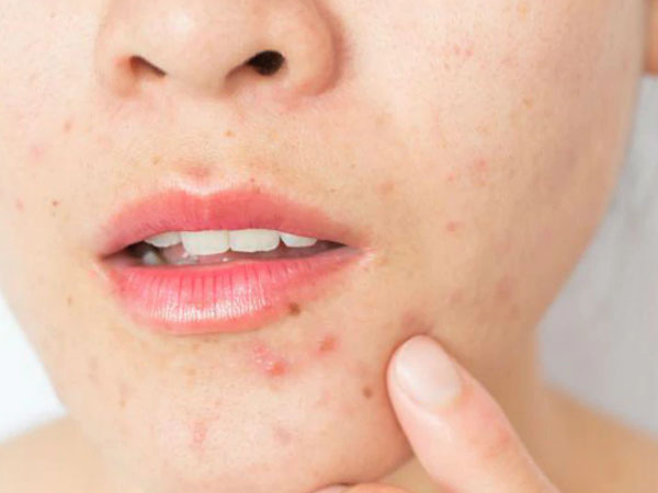 मुहांसे कम होते है