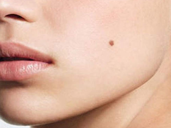 तिल होने का कारण