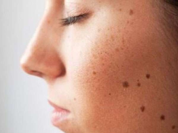चेहरे पर तिल हटाने के उपाय