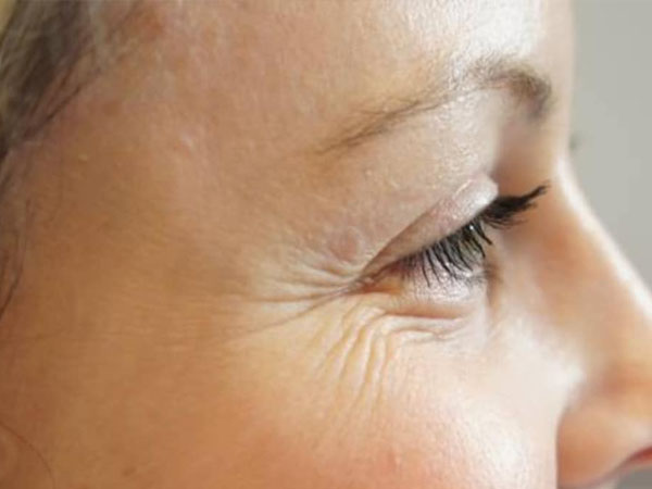 आंखों पर झुर्रियां क्यों पड़ती है। 