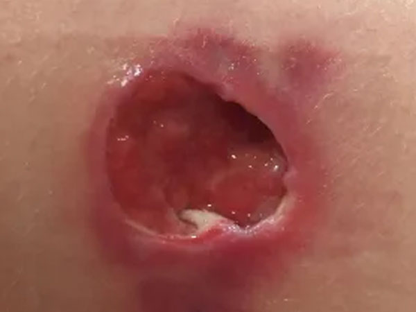 ये होते है शुरुआती लक्षण