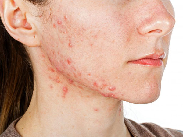एक्ने से पाएं निजात