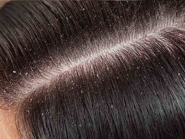 डैंड्रफ से छुटकारा