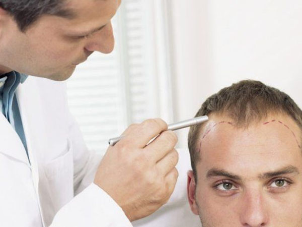 कैसे किया जाता है हेयर ट्रांसप्लांट