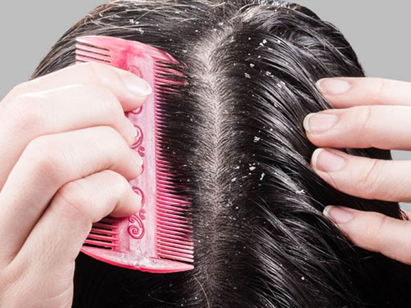 बालों में डैंड्रफ का कारण