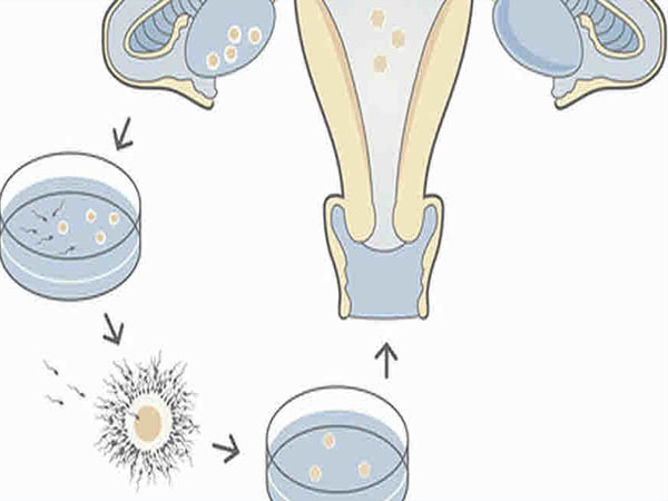  एसिस्टेड रिप्रॉडक्टिव टेक्नोलॉजी के प्रकार