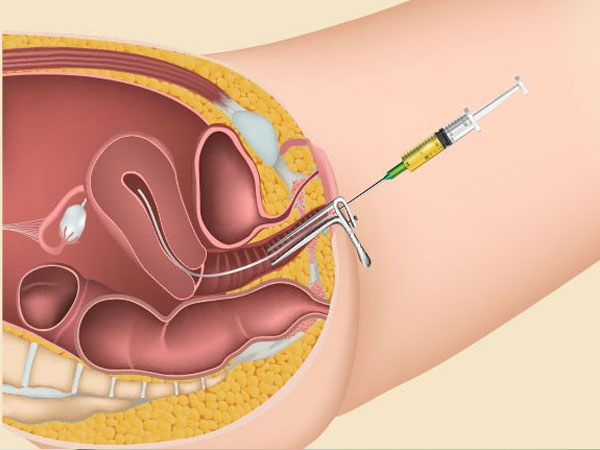 आईयूआई या अंतर्गर्भाशयी गर्भाधान
