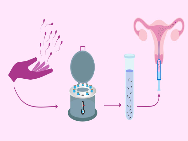 डोनर स्पर्म गर्भाधान