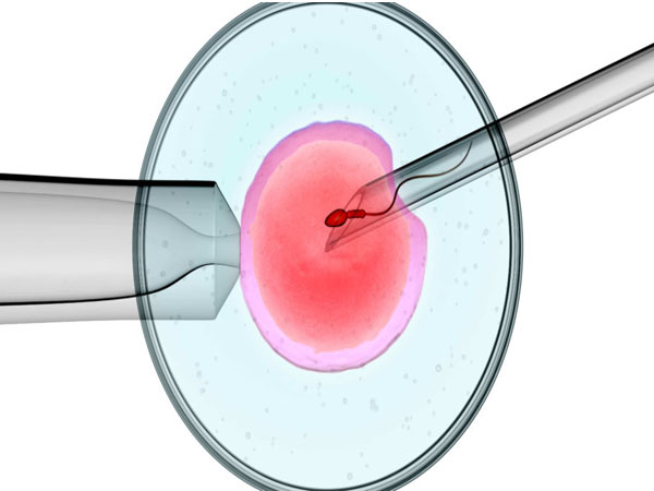 इंट्रासाइटोप्लास्मिक स्पर्म इंजेक्शन