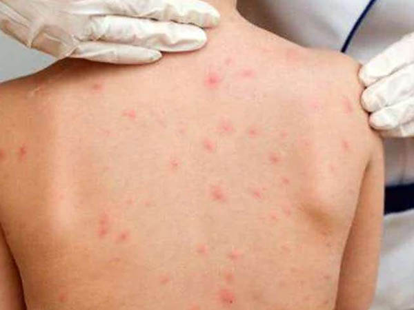 मिल्टी सिस्टम इंफ्लेमेटरी सिंड्रोम लक्षण