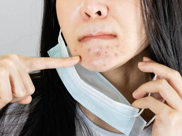 पिंपल से निजात पाने के लिए क्या करें 