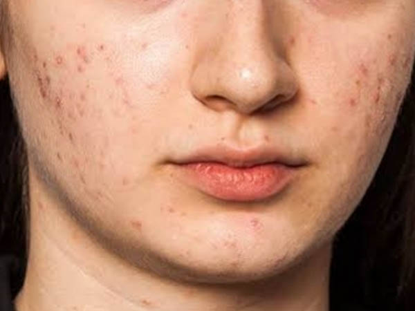 लौंग के तेल का करें इस्तेमाल