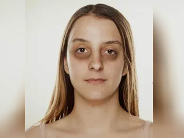 डार्क सर्कल से निजात पाने के टिप्स 