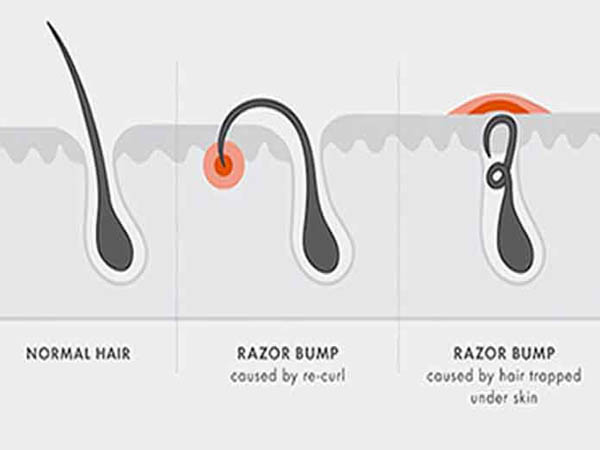 रेजर बंप क्या है