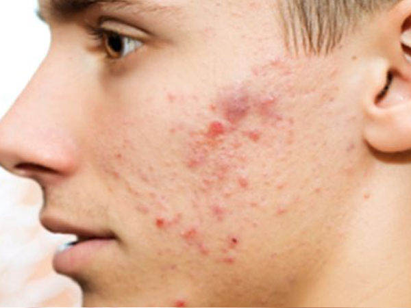 पिंपल से निजात 