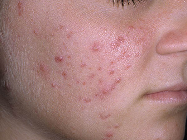 पिंपल और एक्ने के लिए चावल का पानी 