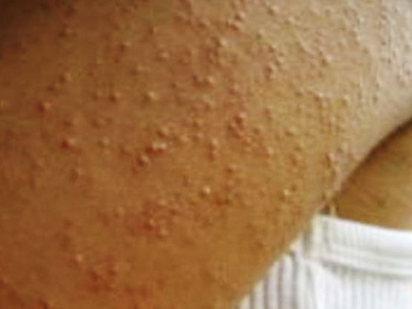 केराटोसिस पिलारिस के लक्षण