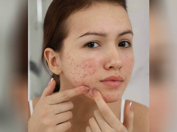 रेटिनाइड्स क्रीम