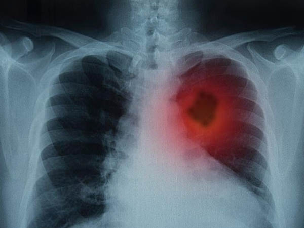 फेफड़ों का कैंसर क्या है?