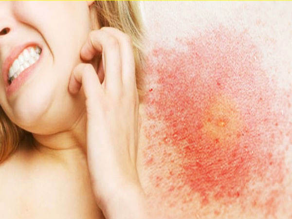 जलन और रेडनेस