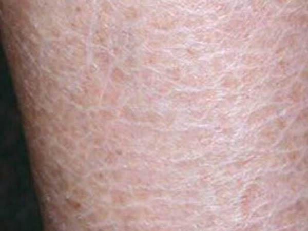 त्वचा पर पपड़ी बन जाना