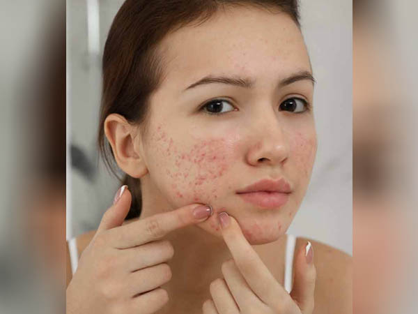 पिंपल और एक्ने ब्रेकआउट