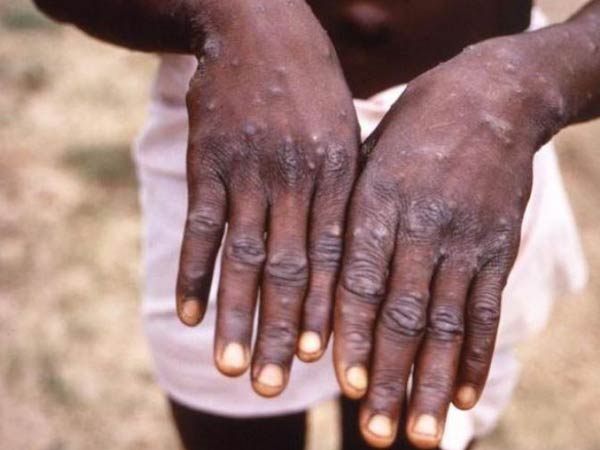 Expert says Monkeypox likely spread by sex at 2 raves in Europe