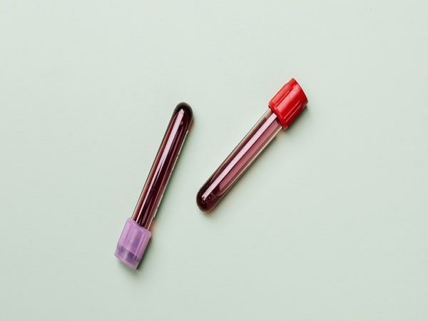 थैलेसीमिया प्रजनन क्षमता को कैसे प्रभावित करता है? थैलेसीमिया प्रजनन क्षमता को कैसे प्रभावित करता है?