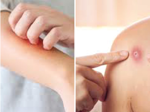 कोविड-19 और मंकी पॉक्स में अंतर