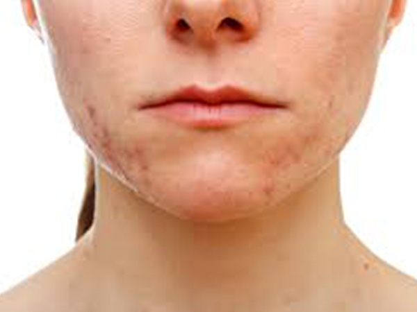 एंडोमेट्रियोसिस एक्ने क्या है?