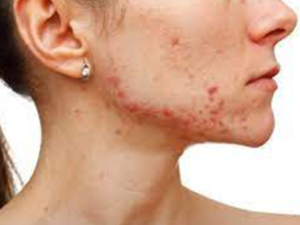 एंडोमेट्रियोसिस एक्ने क्यों होते है?