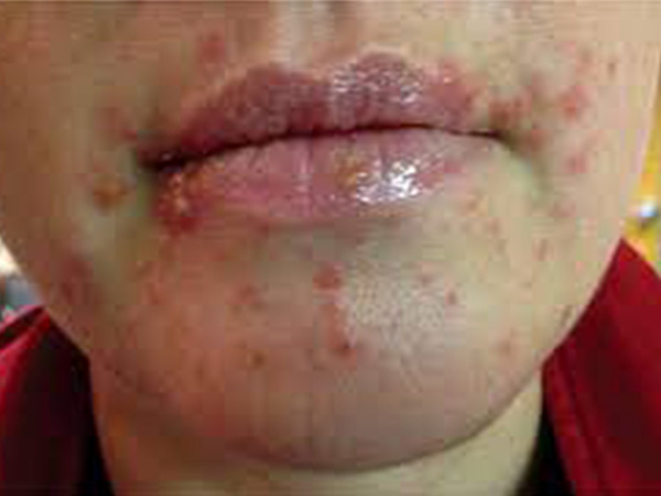 पाचन तंत्र पर करता है अटैक